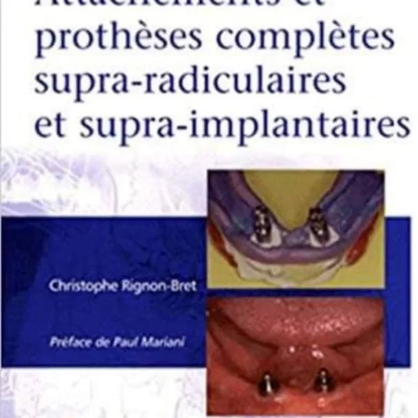 Attachements et protheses completes supra-radiculaires et supra-implantaires