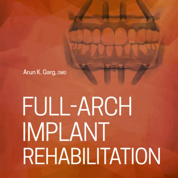 Full-Arch Implant Rehabilitation