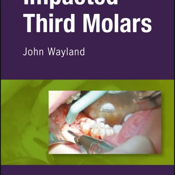 Impacted Third Molars